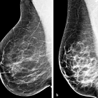 M.E. Brandan: por mejores técnicas para detectar cáncer de mama