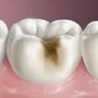 Tratamiento láser aumenta resistencia del esmalte dental
