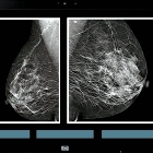Se necesitan protocolos de control de calidad en los programas de detección de cáncer de mama.
