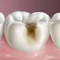 Icon-caries